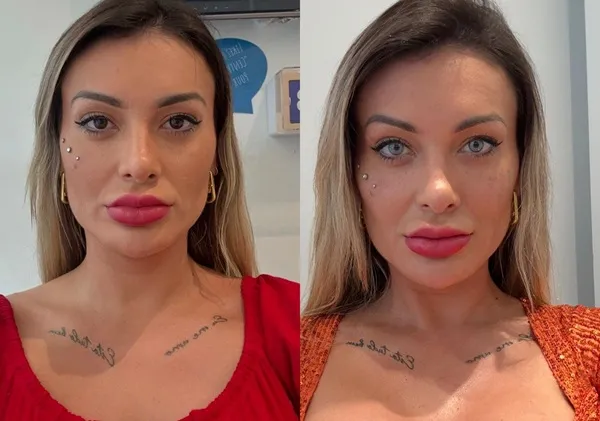 Andressa Urach tem complicações após mudar cor dos olhos; entenda